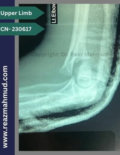 230617 communited condylar humerus preoperative