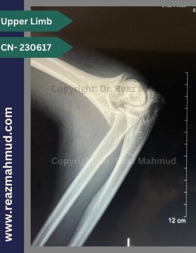 230617 communited condylar humerus preoperative