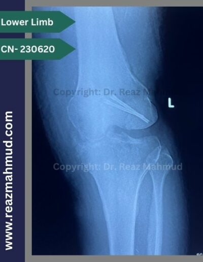 230620- Hoffa Fracture follow up