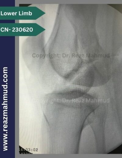 230620- Hoffa Fracture peroperative