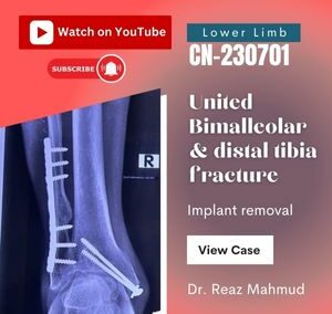United bimalleolar & distal tibia fracture | Implant removal [CN-230701]