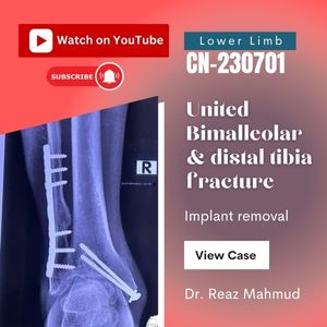 United bimalleolar & distal tibia fracture | Implant removal [CN-230701]