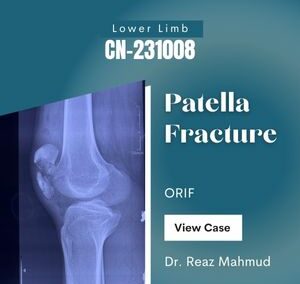 Patella fracture | ORIF [CN-231008]
