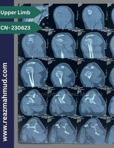 231116- Humeral Head Fracture 3D CT