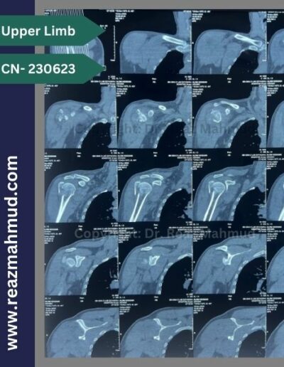 231116- Humeral Head Fracture 3D CT