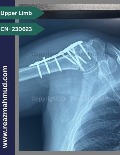 231116- Humeral Head Fracture Follow up