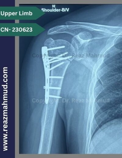 231116- Humeral Head Fracture Follow up