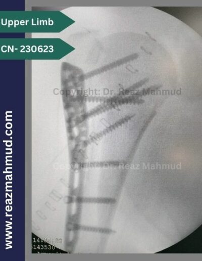 231116- Humeral Head Fracture Peroperative