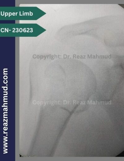 231116- Humeral Head Fracture Peroperative