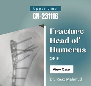 Humeral head fracture | PHILOS [CN-231116]