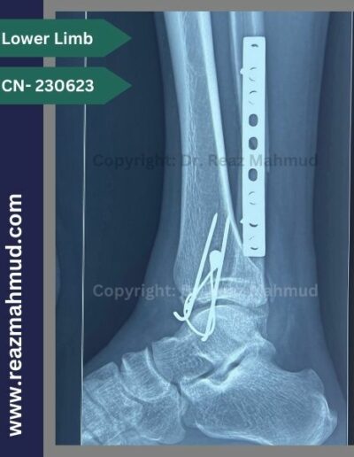 231117- Bimalleolar fracture Postoperative