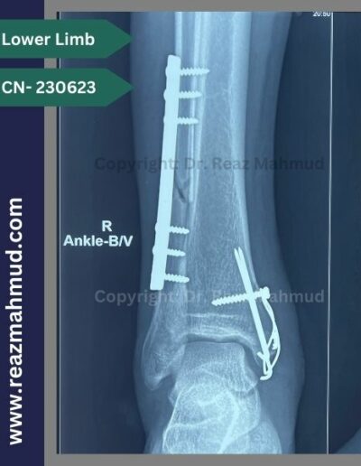 231117- Bimalleolar fracture Postoperative