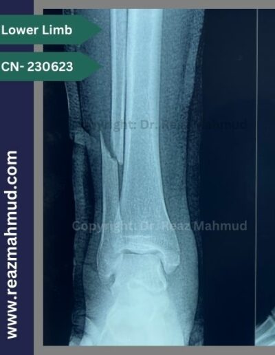 231117- Bimalleolar fracture Preoperative