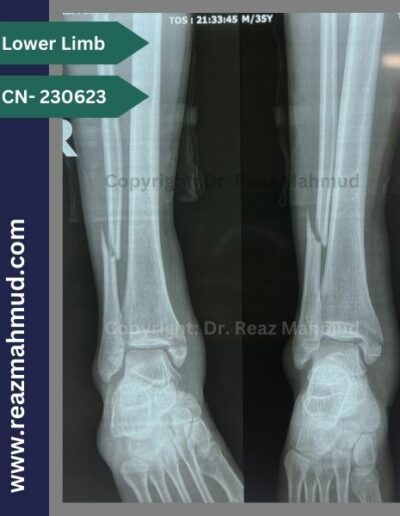 231117- Bimalleolar fracture Preoperative