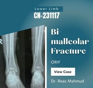 Bimalleolar fracture | ORIF [CN-231117]