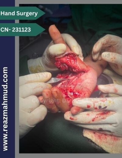 Lacerated Hand peroperative