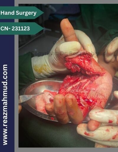 Lacerated Hand peroperative