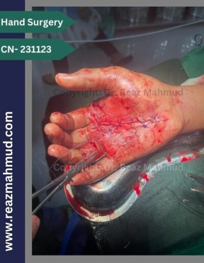 Lacerated Hand peroperative