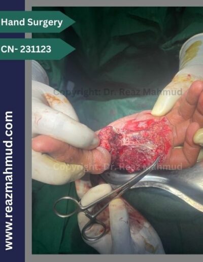 Lacerated Hand peroperative