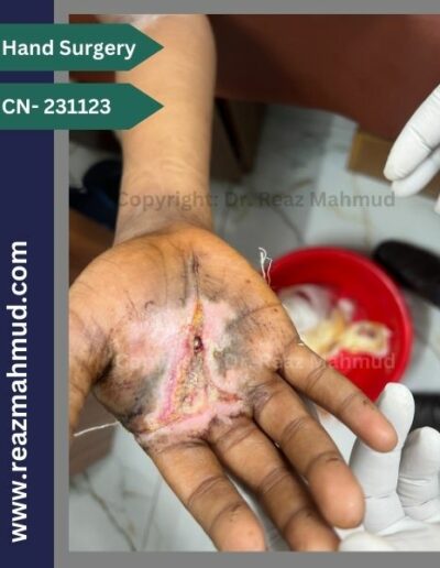 Lacerated Hand postoperative