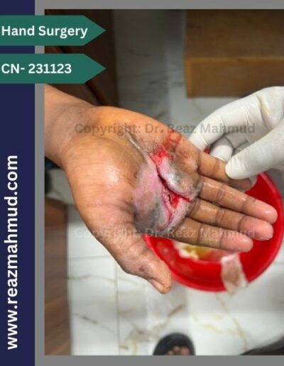 Lacerated Hand postoperative