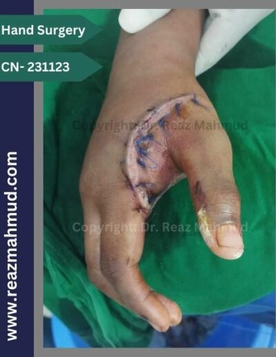 Lacerated Hand postoperative