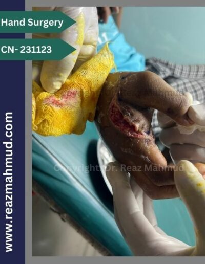 Lacerated Hand postoperative