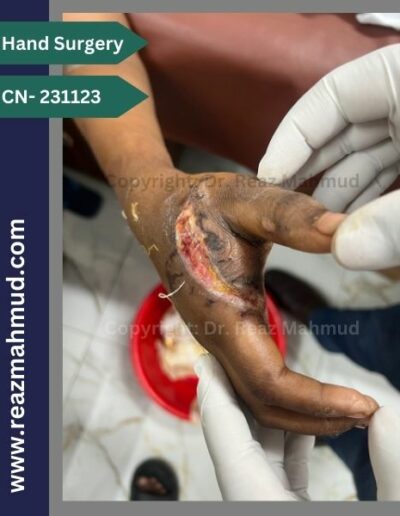 Lacerated Hand postoperative