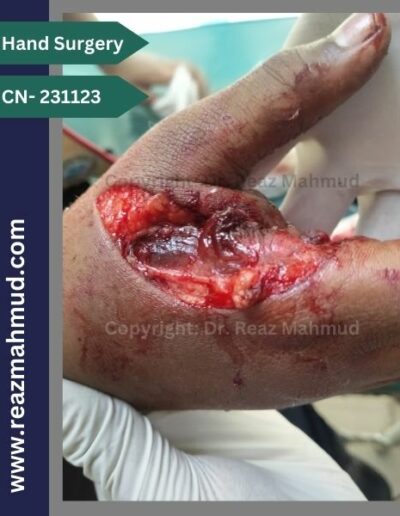 Lacerated Hand preoperative