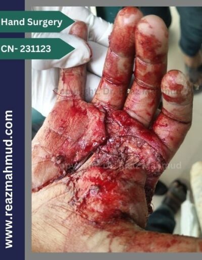 Lacerated Hand preoperative