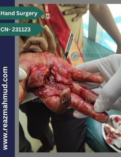 Lacerated Hand preoperative