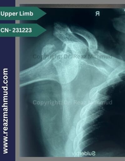 Fracture Dislocation of right shoulder clavicle facture