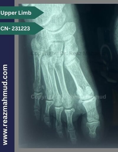 231223 Fracture base of proximal phalanx of 2nd toe