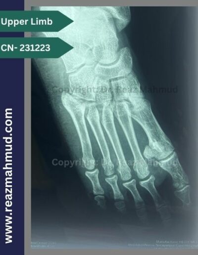 231223 Fracture base of proximal phalanx of 2nd toe LV