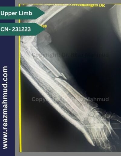 Fracture of shaft ofRadius