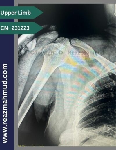 231223 correction of shoulder dislocation