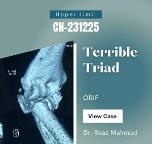 Terrible Triad | Radial Head Excision & Cornoid Process Fixation [CN-231225]