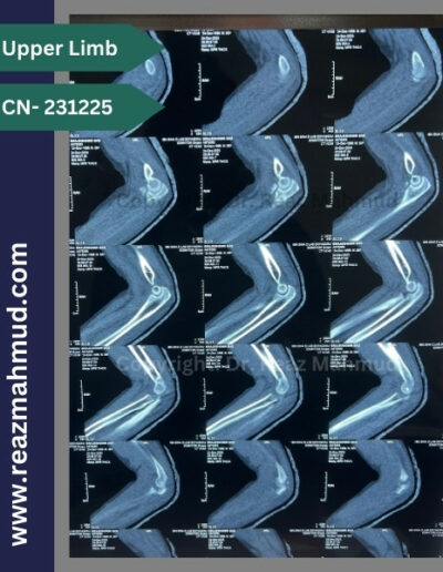 3D CT Terrible Triad