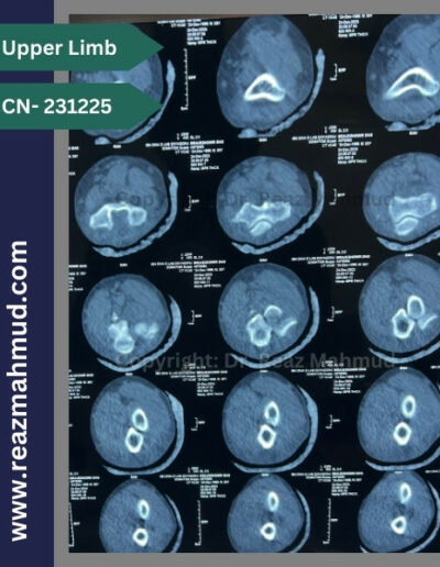 3D CT Terrible Triad