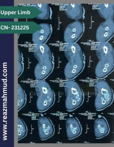 3D CT Terrible Triad