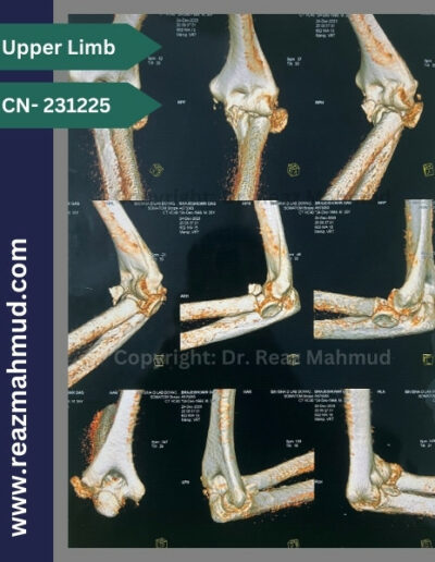 3D CT Terrible Triad