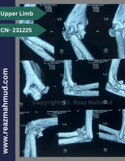 3D CT Terrible Triad