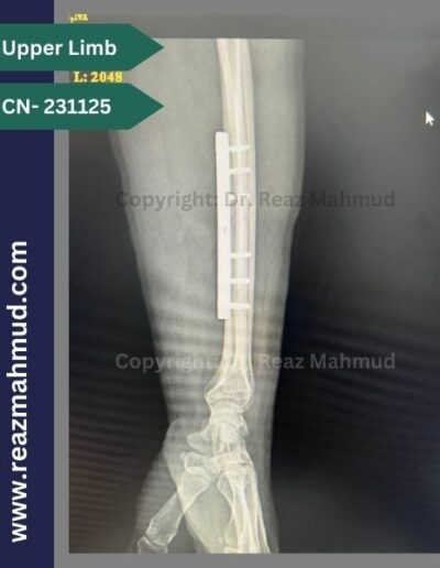 231125- Bilateral Radius Follow Up