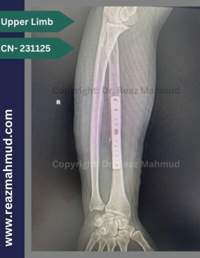 231125- Bilateral Radius Follow Up