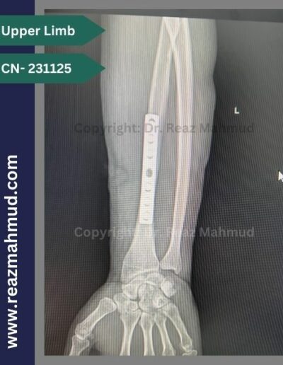 231125- Bilateral Radius Follow Up