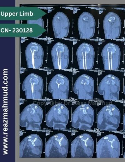 Fracture Dislocation of humerus head 3d CT