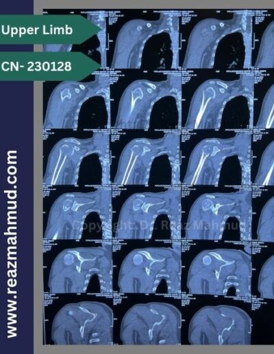 Fracture Dislocation of humerus head 3d CT