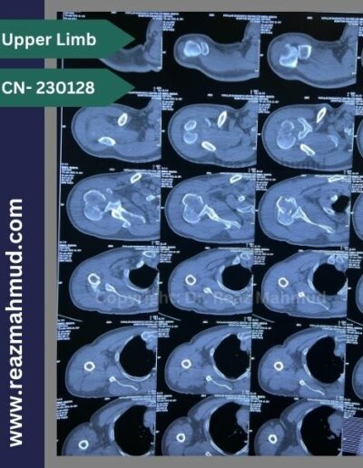 Fracture Dislocation of humerus head 3d CT