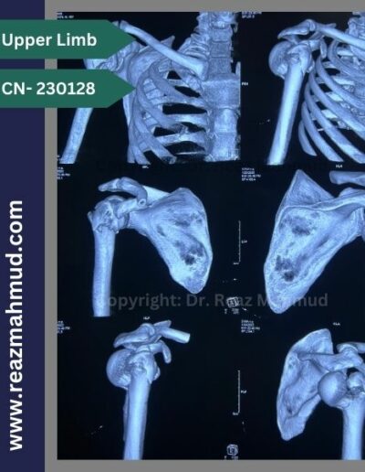 Fracture Dislocation of humerus head 3d CT