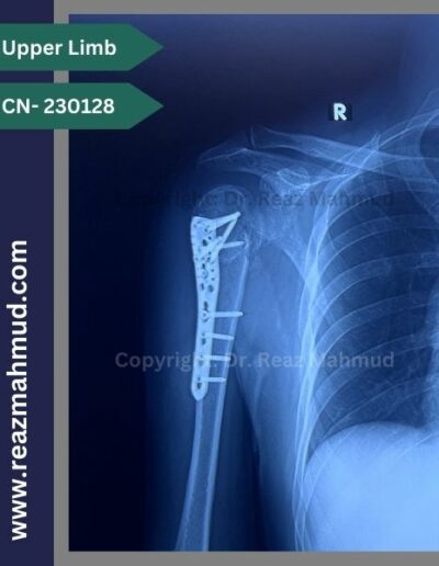 Fracture Dislocation of humerus head Follow up